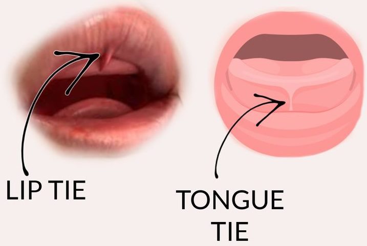 tongue tie and lip tie
